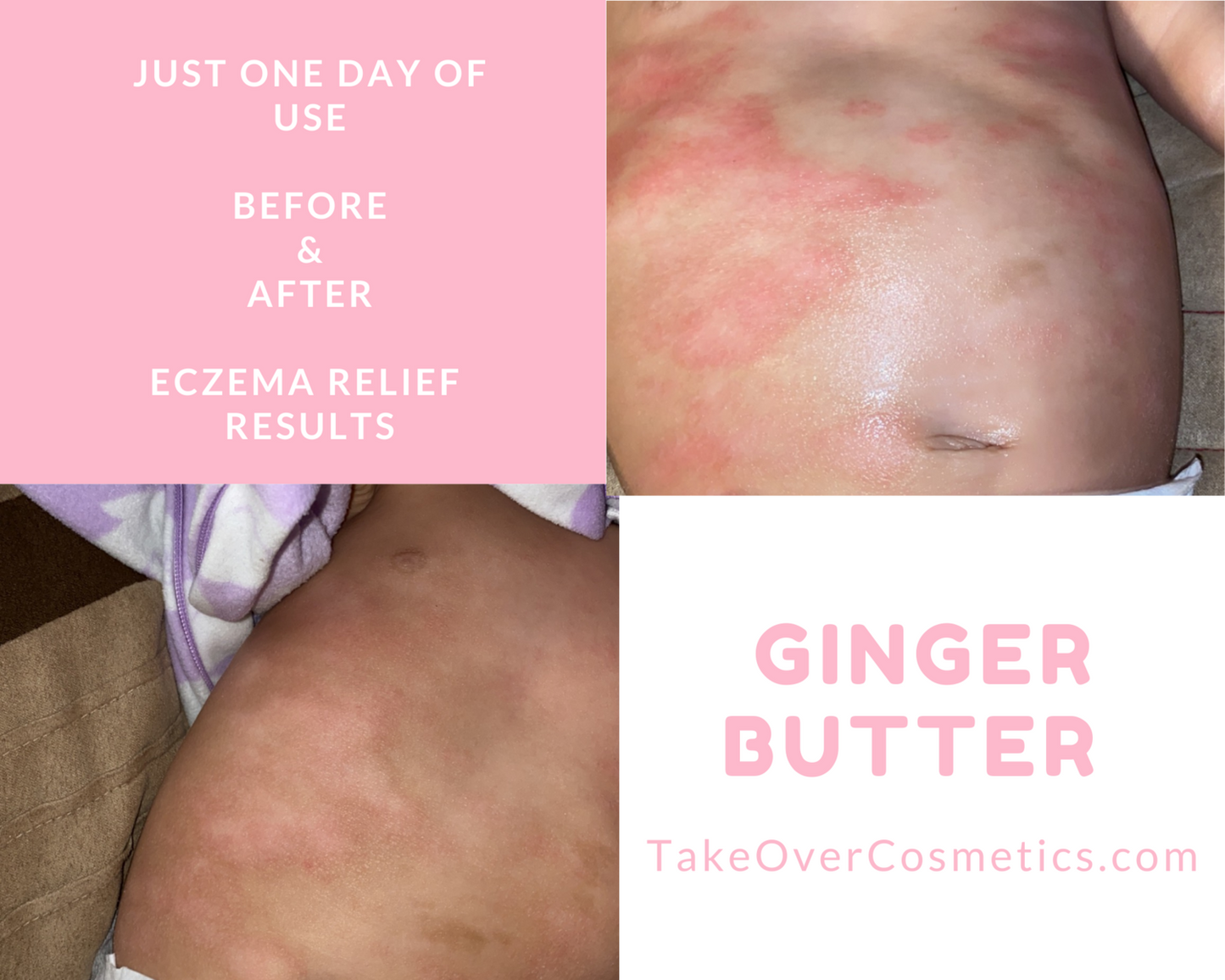 Ginger Eczema Soothing Body Butter